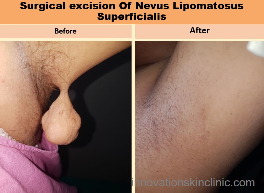 Surgeries For Benign Skin - Nevus Lipomatosus Superficialis